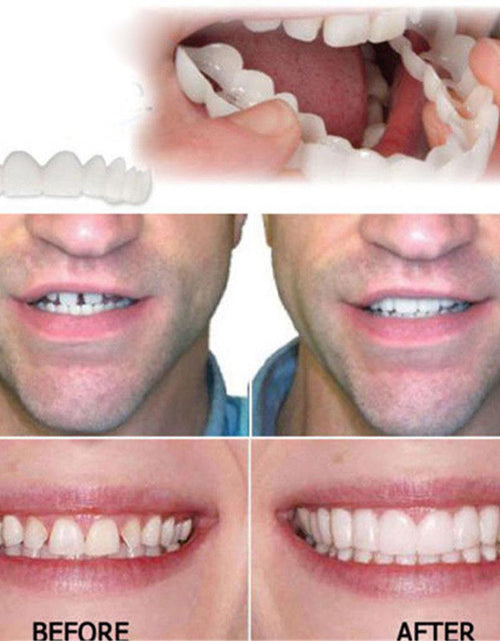 Load image into Gallery viewer, Whitening Braces Simulation Teeth Denture Brace
